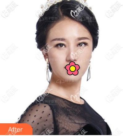 初次整鼻子做壞了,在包頭葉子整形做了肋軟骨隆鼻修復(fù)后,終于把塌鼻梁和大鼻頭甩掉了!