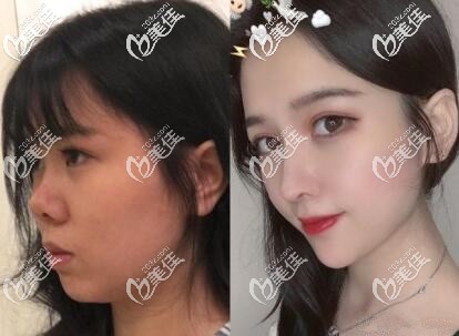 北京薇琳劉勇鼻綜合案例