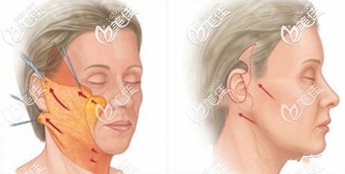 小切口提升術(shù)原理