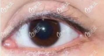 內(nèi)眼角開的過大 內(nèi)眼角開的過大