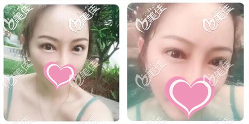 還認(rèn)為割雙眼皮做提肌是騙局的,有必要看眼部提肌是怎么做的圖解再判斷