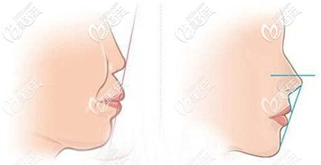 凸嘴的改善對(duì)唇部的變化