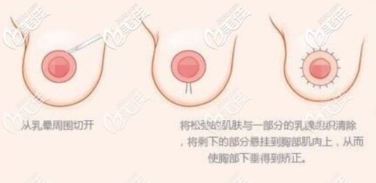 雙環(huán)法乳房懸吊原理 雙環(huán)法乳房懸吊原理