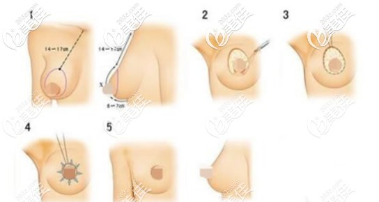 乳房塑形懸吊法提升胸部原理 乳房塑形懸吊法提升胸部原理