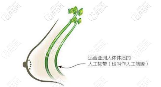 人工韌帶乳房上提術(shù) 人工韌帶乳房上提術(shù)