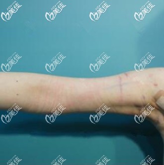 威塑吸脂瘦手臂術后當天照