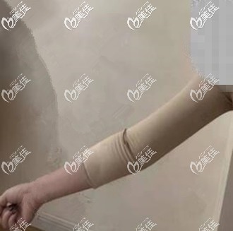 威塑吸脂瘦手臂術后一周恢復效果照