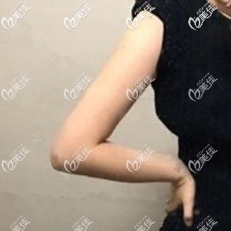 用我在泰國(guó)然禧yanhee整形醫(yī)院做威塑吸脂瘦手臂的真實(shí)經(jīng)歷來告訴你效果如何！