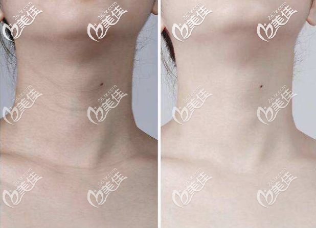 <!--<i data=20240703-sp></i>-->潤(rùn)百顏玻尿酸去頸紋效果 <!--<i data=20240703-sp></i>-->潤(rùn)百顏玻尿酸去頸紋效果