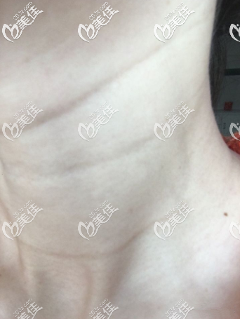 皺紋變淡了 皺紋變淡了