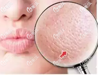 皮秒可以收縮毛孔 皮秒可以收縮毛孔