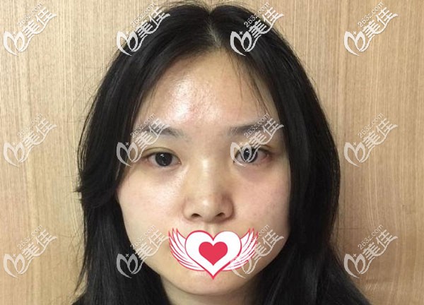 肋軟骨隆鼻手術(shù)前 肋軟骨隆鼻手術(shù)前