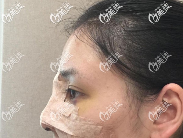 做鼻子第7天拆線后恢復(fù)的超快 做鼻子第7天拆線后恢復(fù)的超快