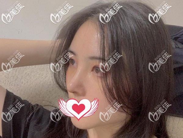 做完鼻子2個月基本已經(jīng)定型 做完鼻子2個月基本已經(jīng)定型