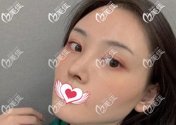 自體肋軟骨隆鼻3個月鼻子變挺了 自體肋軟骨隆鼻3個月鼻子變挺了