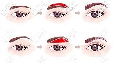 提眉手術(shù)的原理和維持時(shí)間