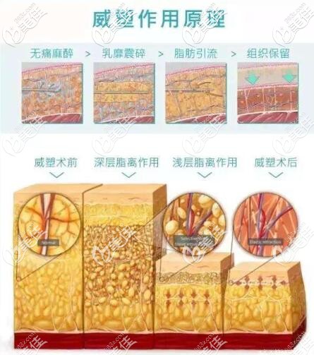 威塑吸脂原理 威塑吸脂原理