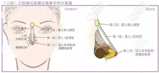 鼻假體放置的位置 鼻假體放置的位置