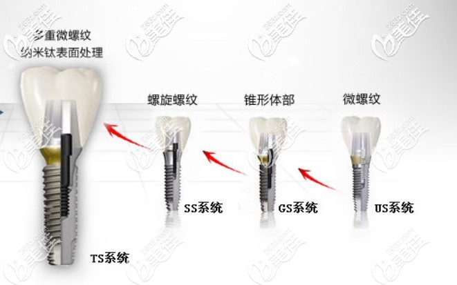 奧齒泰種植體型號有以下這幾種