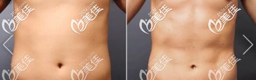 威塑吸脂瘦腰腹部真人前后對比照