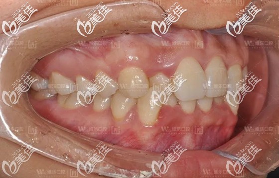 矯正前的側(cè)面口內(nèi)照