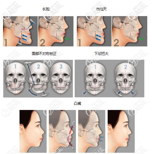 韋氏-兩顎正頜術(shù)可以解決改善多種問題