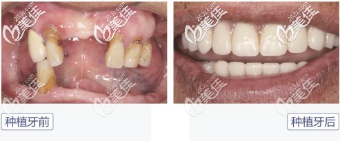 牙掉了千萬別鑲牙，爺爺在北京朝陽區(qū)做的allon4全口種植牙價格雖然不便宜但用起來和真牙一樣