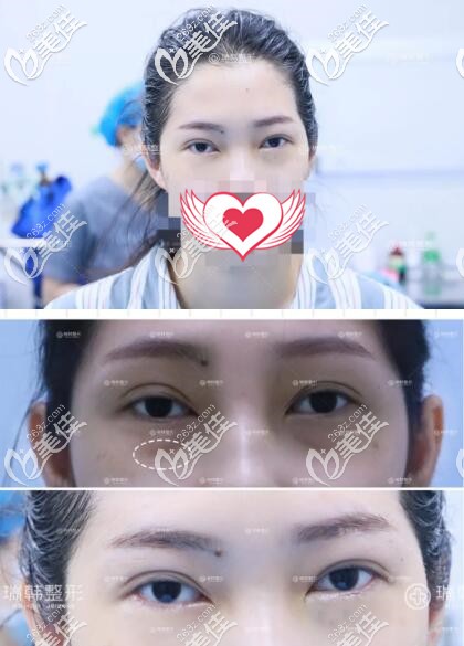 在瑞海去眼袋術(shù)后即刻效果照