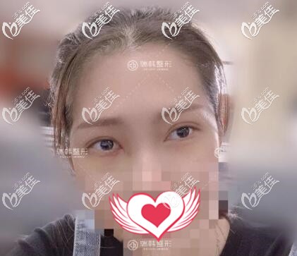 在海南做去眼袋術(shù)后一周效果照