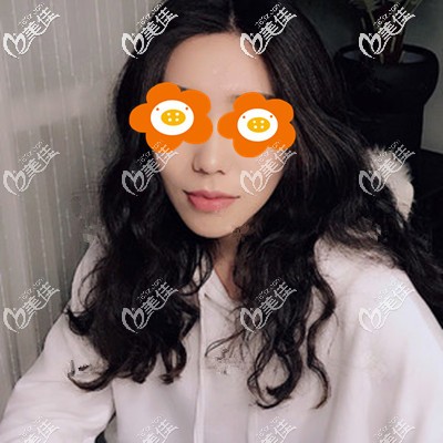 去痘坑痘印一個月圖片 去痘坑痘印一個月圖片