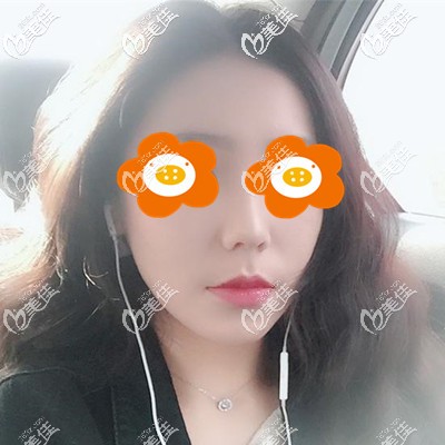 臉上的痘坑痘印怎么治療才能好？我在福州瑪恩做激光美膚的案例你拿去參考