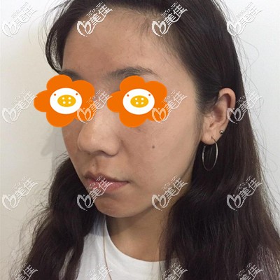 術后第7天 術后第7天