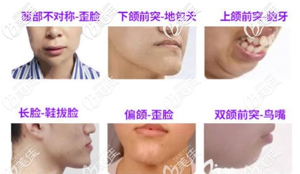 哪些人需要做正頜手術(shù) 哪些人需要做正頜手術(shù)