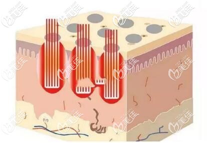 點陣激光去痘坑的作用 點陣激光去痘坑的作用