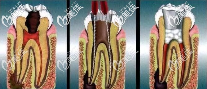 牙齒根管治療