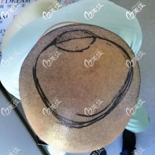 頭發(fā)都剃掉我我頭頂看起來也禿了一大塊 頭發(fā)都剃掉我我頭頂看起來也禿了一大塊