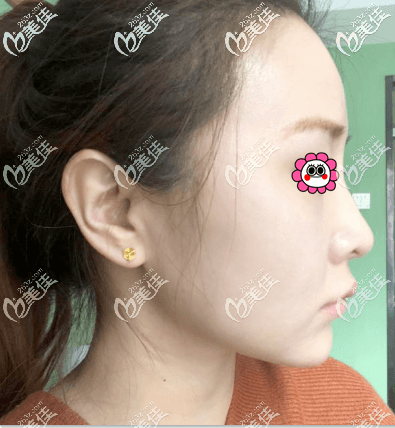 我做一針降顴骨第7天效果圖