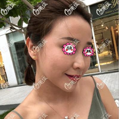 我做一針降顴骨后臉感覺沒有出現(xiàn)更大的現(xiàn)象效果還可以