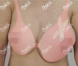 胸部奧美定游離乳房大小不一