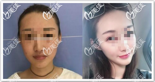 真人案例：八爪魚面部提升三個月效果對比