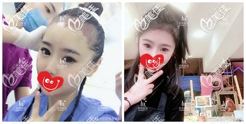 發(fā)際線種植前后對比照片 發(fā)際線種植前后對比照片