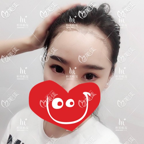 發(fā)際線種植術(shù)前照片 發(fā)際線種植術(shù)前照片