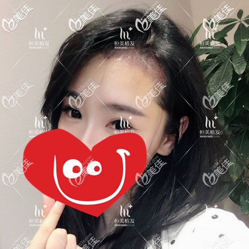 前額發(fā)際線種植術(shù)后即刻 前額發(fā)際線種植術(shù)后即刻