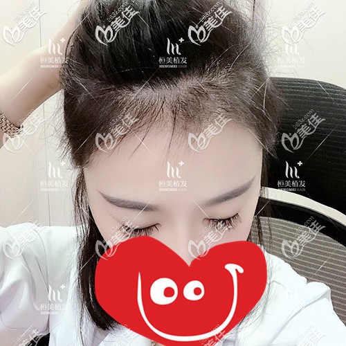 發(fā)際線種植5個(gè)月效果 發(fā)際線種植5個(gè)月效果