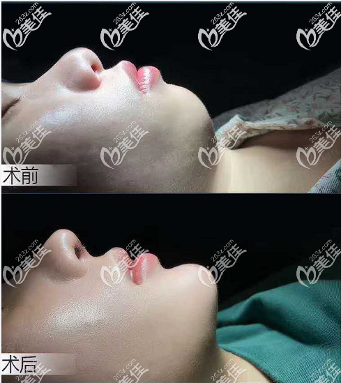 廣州星團(tuán)醫(yī)美蔡澤翔醫(yī)生做的假體墊下巴案例