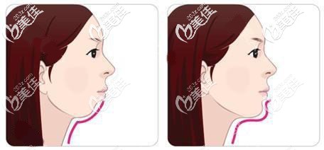 下巴后縮正畸矯正 下巴后縮正畸矯正