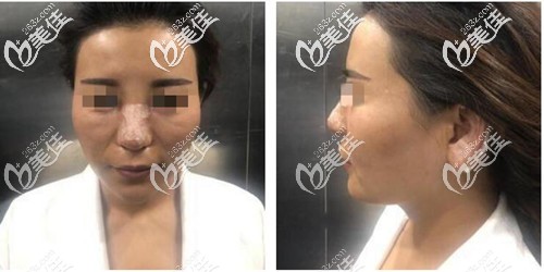 膨體加耳軟骨隆鼻恢復(fù)期照片 膨體加耳軟骨隆鼻恢復(fù)期照片