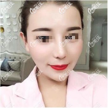 說膨體隆鼻感染是遲早問題的,看我的膨體加耳軟骨保持很久還很自然的圖片再評價(jià)