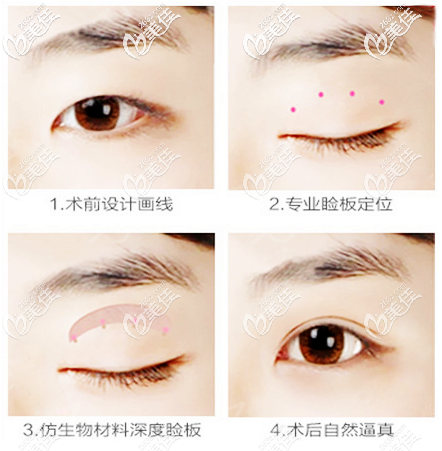 廣州星團(tuán)醫(yī)美蔡澤翔做色雙眼皮案例效果過(guò)程圖 廣州星團(tuán)醫(yī)美蔡澤翔做色雙眼皮案例效果過(guò)程圖