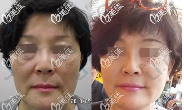 葡聚糖改善面部松弛下垂+去眼袋效果+消除八字紋效果 葡聚糖改善面部松弛下垂+去眼袋效果+消除八字紋效果